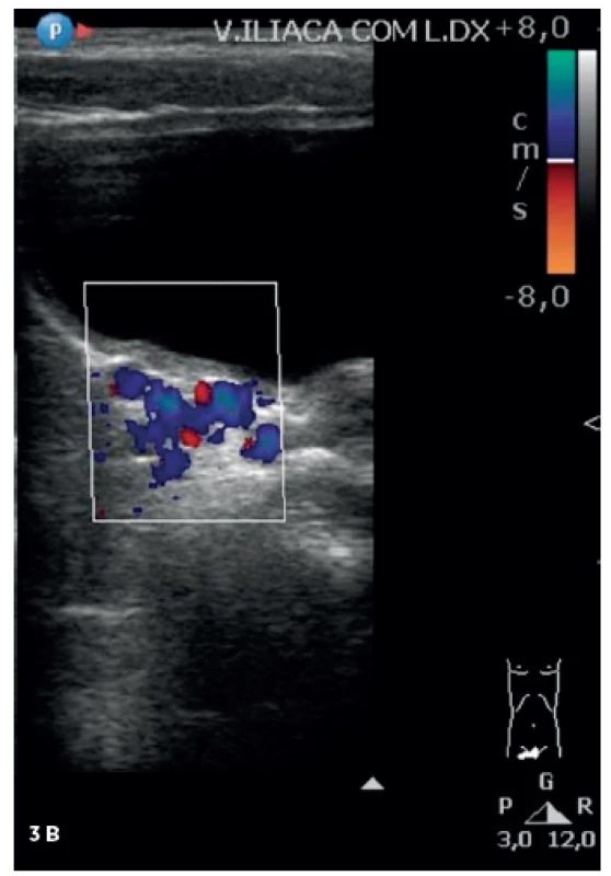 Kontrolné dopplerovské vyšetrenie.
Fig. 3. Repeated doppler ultrasound.