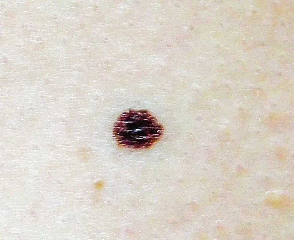 Povrchově se šířící melanom <i>in situ</i> levé strany hrudníku
