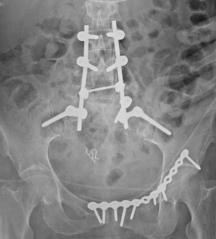 Zajištění nestabilního poranění lumbosakrálního přechodu lumbopelvickou fixací, přední segment pánve byl zajištěn dlahou
Fig. 5: Management of unstable lumbosacral injury with lumbopelvic fixation, the anterior pelvic segment was stabilised using a plate
