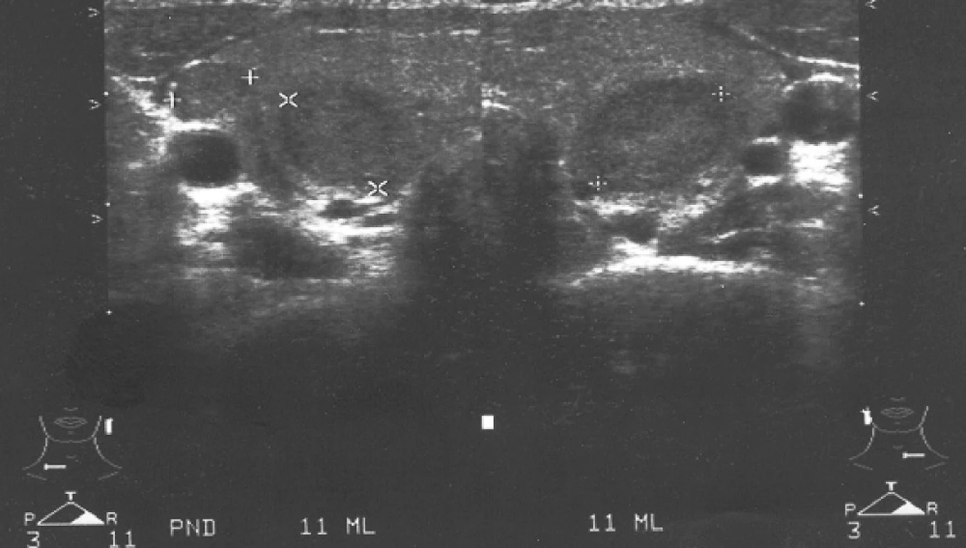 Sonografické vyšetření ve věku 22 let s nálezem dvou solidních izoreflektivních uzlů (průměr 7 a 11 mm) v pravém laloku a jedním větším uzlem (20 × 14 × 9 mm) v levém laloku štítnice
