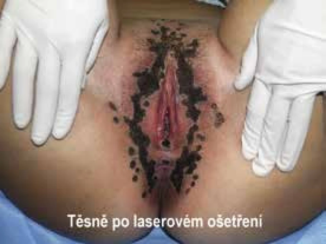 Stav těsně po laserovém ošetření