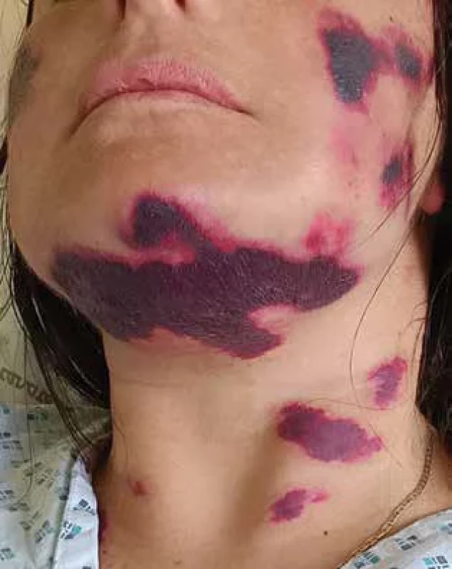 Hemoragické a nekrotické projevy na krku a v obličeji u pacientky s paroxysmální noční hemoglobinurií