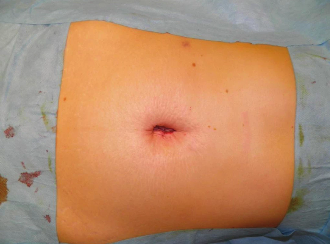 Suturovaná operačná ranka v oblasti umbilika
Fig. 3: The incision after suturing in the umbilicus area