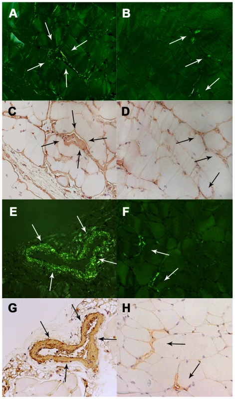 Amyloid deposition in the muscle.