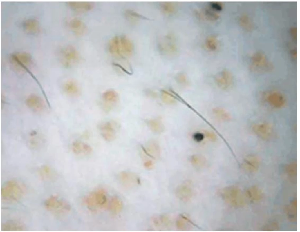 Areátní alopecie – mnohočetné yellow dots u dlouhotrvající a. Universalis