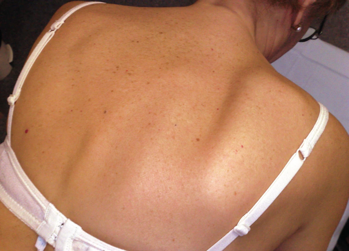Scapula alata vpravo – odstává převážně horní úhel lopatky.