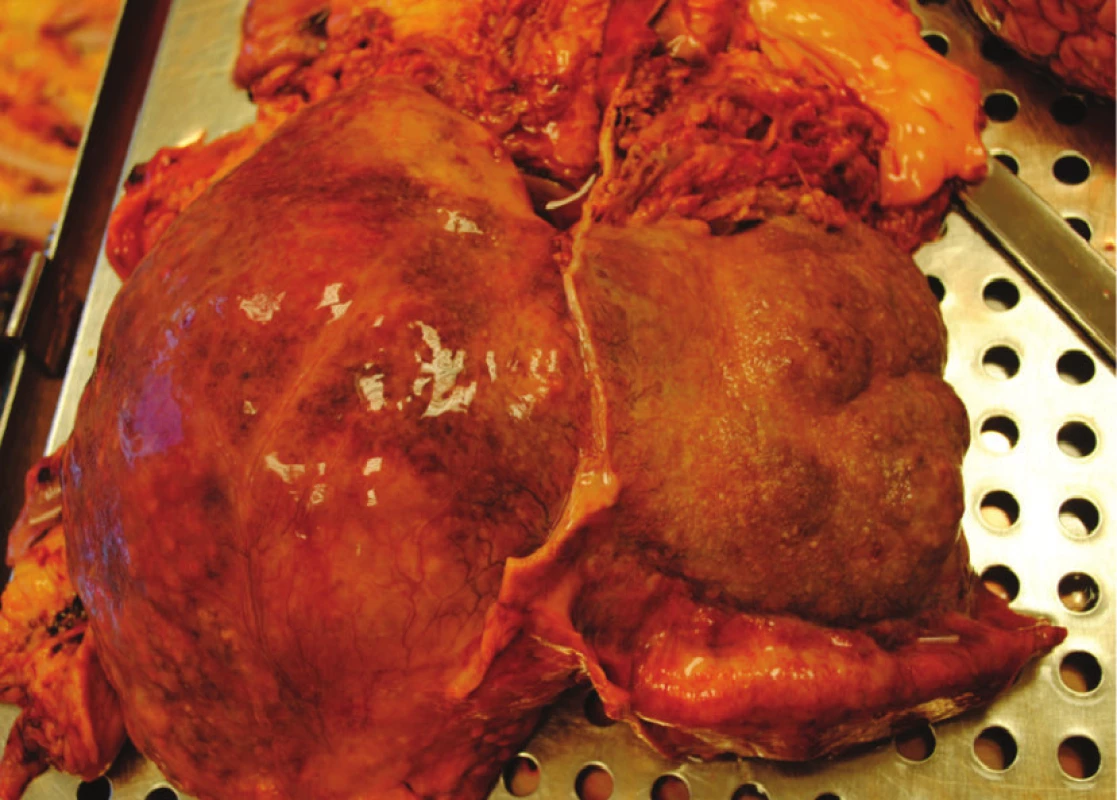 Sekční nález − makronodulární cirhotická játra
Fig. 4: Autopsy fading − macronodular hepatic cirrhosis