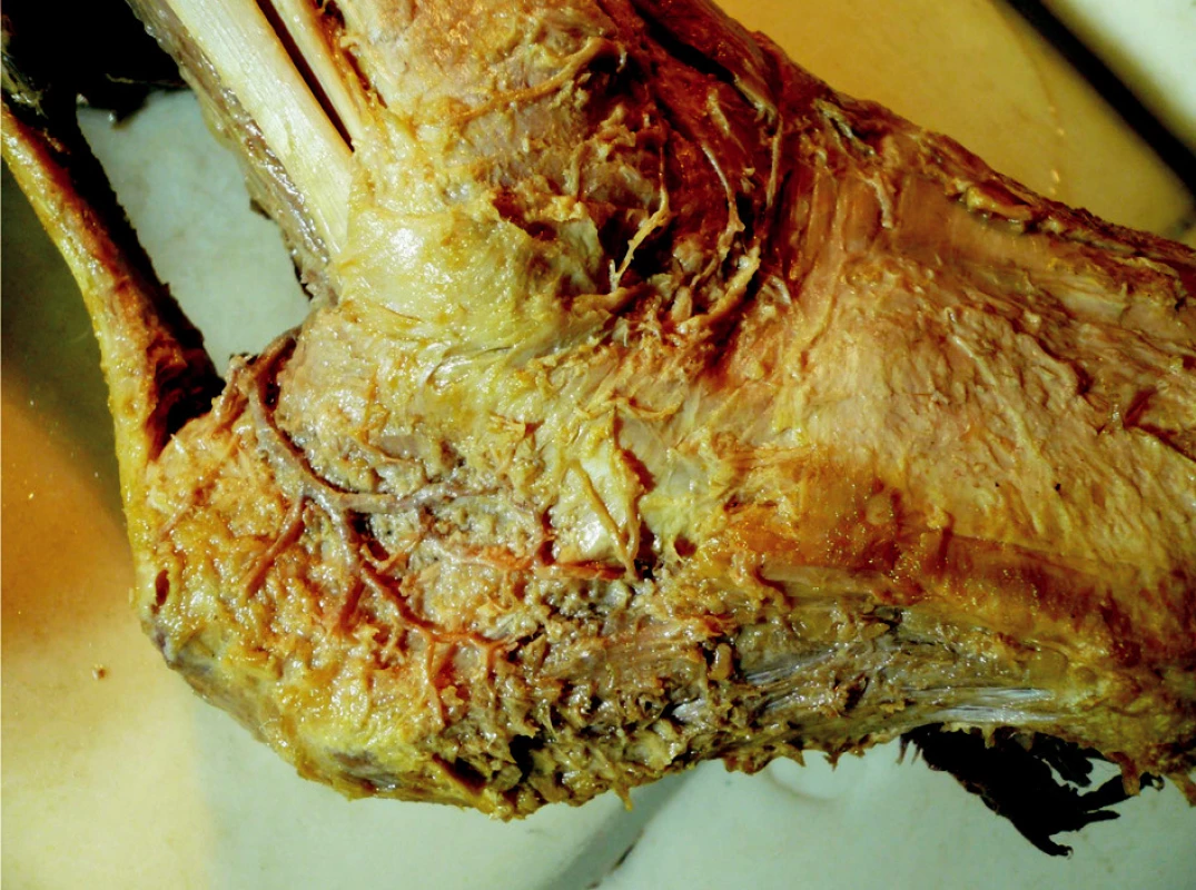 Preparát I – oblast laterální strany paty s označením jednotlivých struktur
Fig. 2. Preparation I – the lateral calcaneus with individual structures highlighted