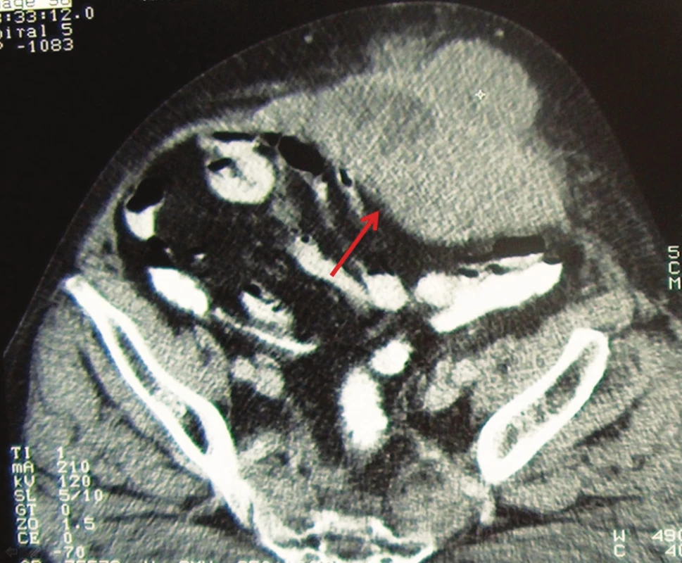 CT obraz metastázy adenokarcinómu do brušnej steny
Fig. 1. CT imaging of metastasis of adenocarcinoma into abdominal wall