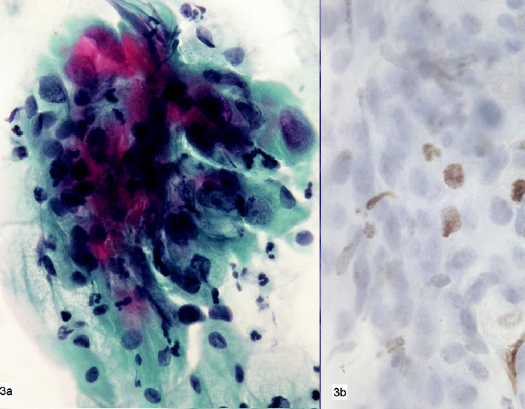 a-b. 70 let
3a. Nátěr – polychrom. Atypická méně zralá metaplazie. Anizokaryóza.
Zánětlivá celulizace. Závěr: ASC US. – 3b. Ojediněle pozitivní
průkaz MIB 1 v odbarveném nátěru. Pozitivity neutrofilních
granulocytů (endogenní peroxidáza blokována)