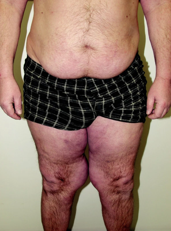 BSL – gynekoidní typ.