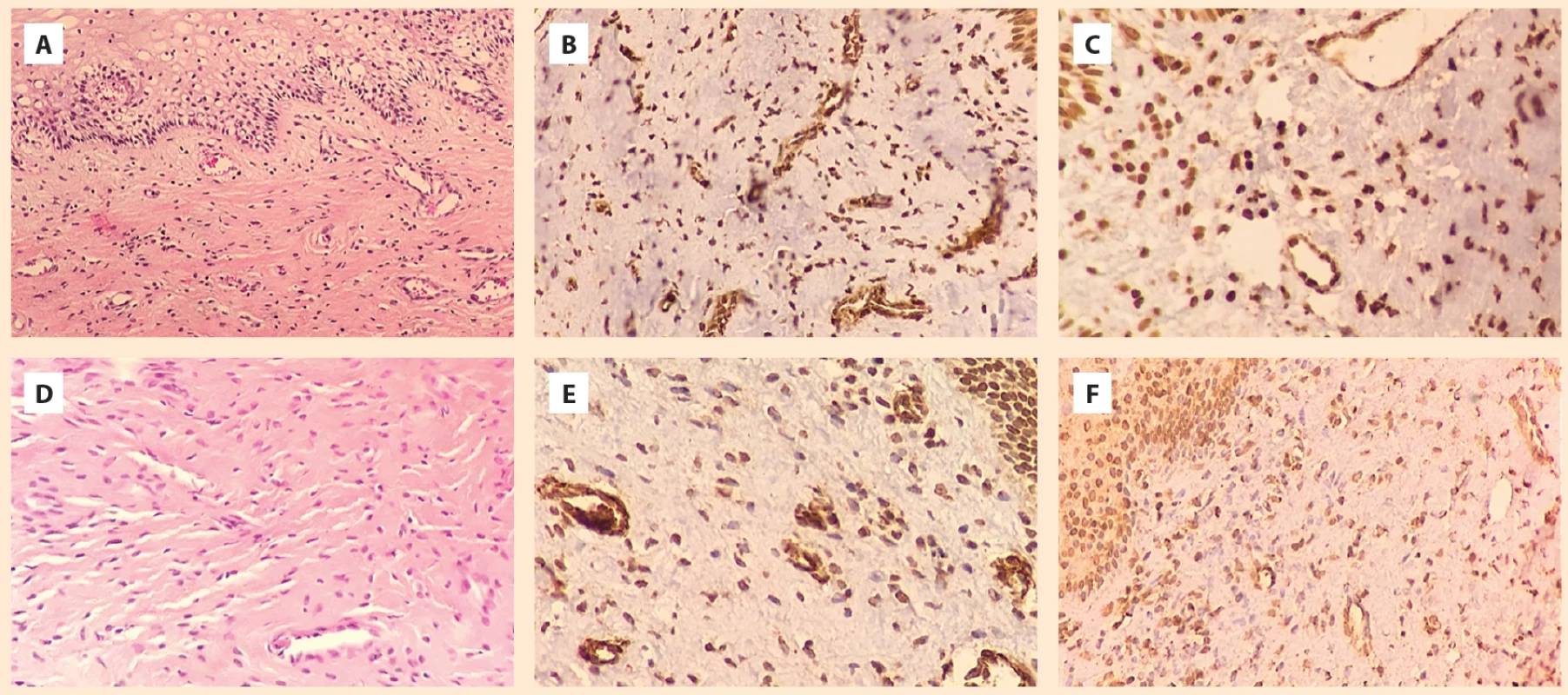 2A) Photomicrograph of a cervical biopsy with mild nonspecifi c cervicitis (HE, 20×). 2B) Photomicrograph of the previous biopsy showing muscle fi bers and small capillaries positive for SMA 1+/3 (SMA, 40×) in the stroma. 2C) Photomicrograph of the previous biopsy showing fi broblasts and small capillaries in the stroma that were not positive for FAP 2+/3 (anti-FAP, 40×). 2D) Photomicrograph of cervical biopsy demonstrating the stroma with small capillaries without alterations (HE, 20×). 2E) Photomicrograph of the anterior biopsy showing positive muscle fi bers and capillaries in the stroma for SMA 2+/3 (SMA, 40×). 2F) Photomicrograph of the previous biopsy demonstrating positive fi broblasts and capillaries in the stroma for FAP 1+/3 (anti-FAP, 40×).