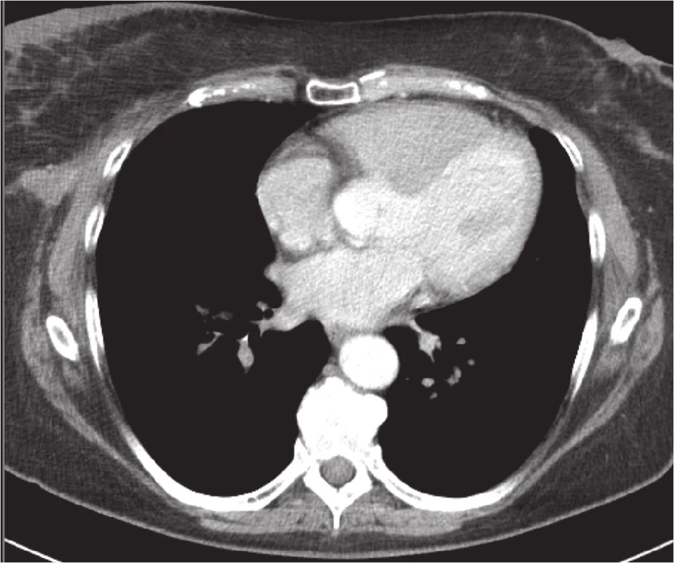 CT hrudníku v prosinci 2010
Fig. 3: Chest CT scan in December 2010