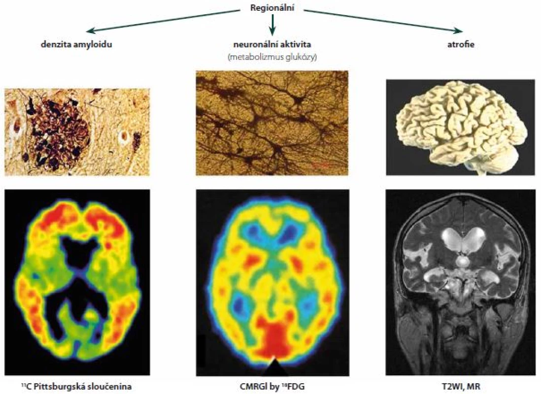 Za předpokladu neurotoxicity amyloidu by měly regionální nálezy jeho denzity souhlasit s lokálním hypometabolismem glukózy a lokální atrofií.
Fig. 2. Providing amyloid as being neurotoxic, the regional findings of its density should correspond with local hypometabolism of glucose and with local atrophy.