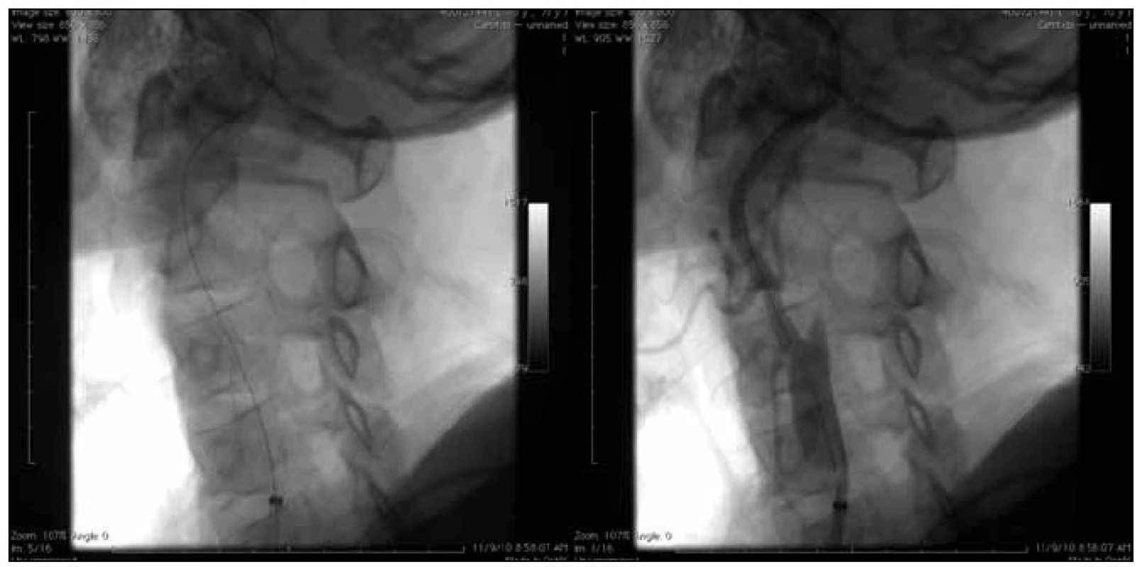Zavedení arteriálního stentu do společné a zevní krkavice s cílem přestentovat odstup vnitřní krkavice. Expandibilní stent 6–8/30 mm.