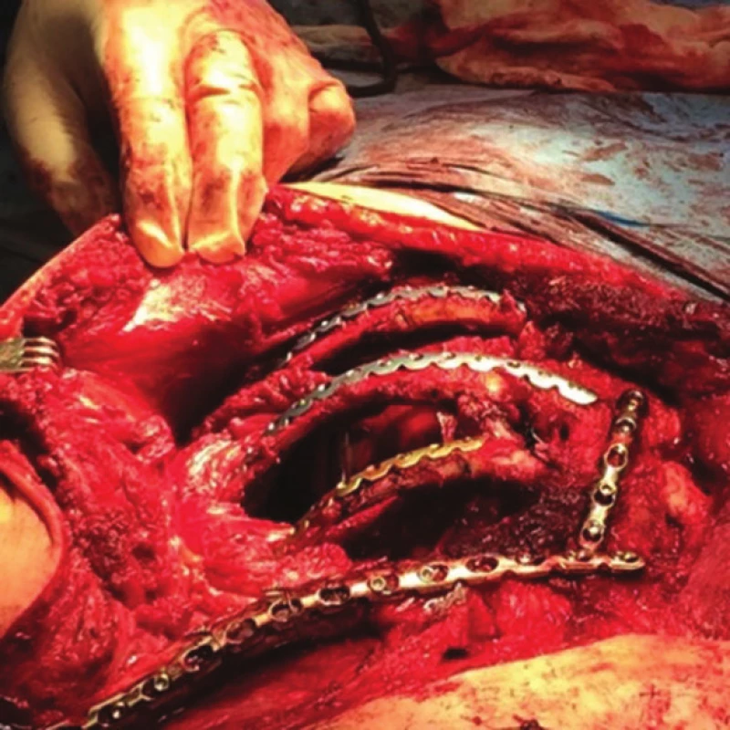 Peroperační nález
Fig. 11: Surgical procedure