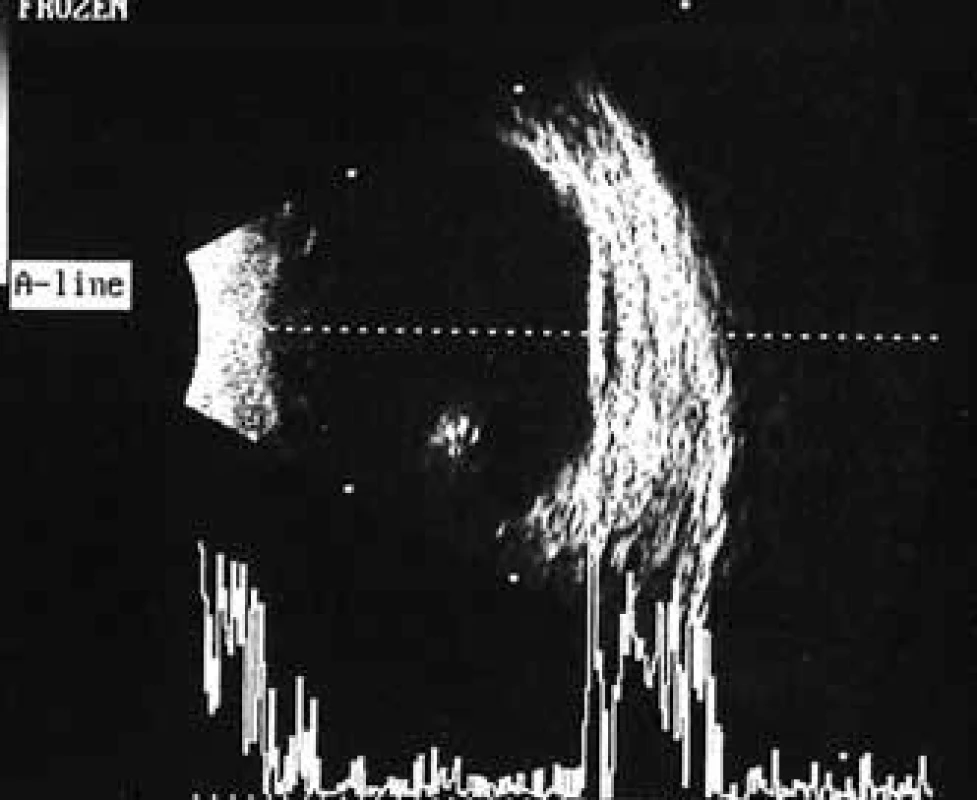 Pacient č. 2: Ultrasonografie oka levého: hemoftalmus, hyperechogení linie v oblasti zadního pólu oka odpovídající trakčnímu odchlípení sítnice.