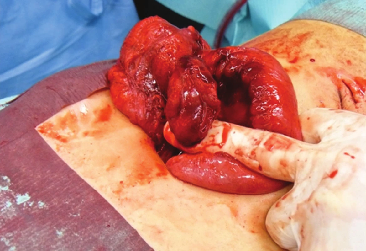 Enormně ztluštěný appendix budící dojem tumoru
Fig. 1: Enormously thickened appendix, giving an impression of being a tumour