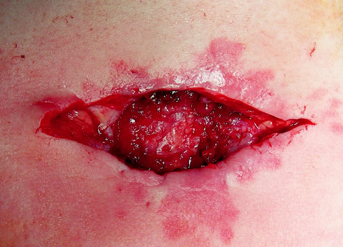 Stav po extrakcii syntetického materiálu a excízii okrajov kože – spodina s pevnou väzivovou membránou
Fig. 3. Situation following synthetic material extraction – bottom with solid connective tissue membrane