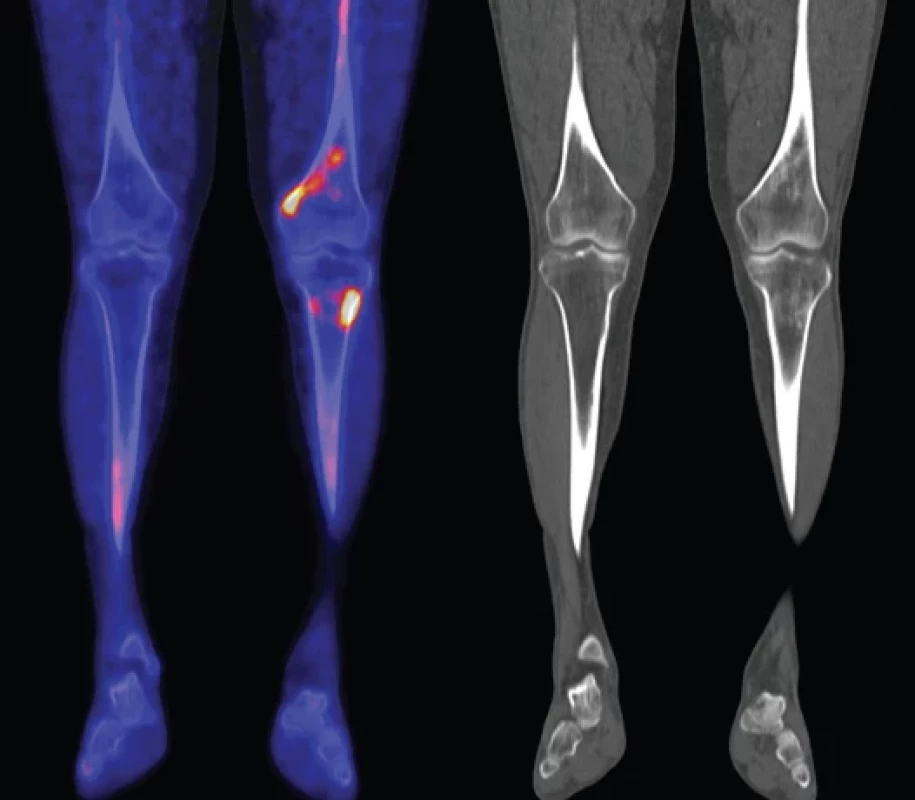 Zobrazení dolních končetin metodou PET/CT s radiofarmakem Na18F (Na18F-PET/CT) končetin, koronární řezy: V distální části levého femuru (diafýza, epifýza) jsou patrné nevýrazné, nehomogenní okrsky sklerotizace, jen některé vykazují zvýšenou akumulaci 18F-NaF v PET/CT obraze.
