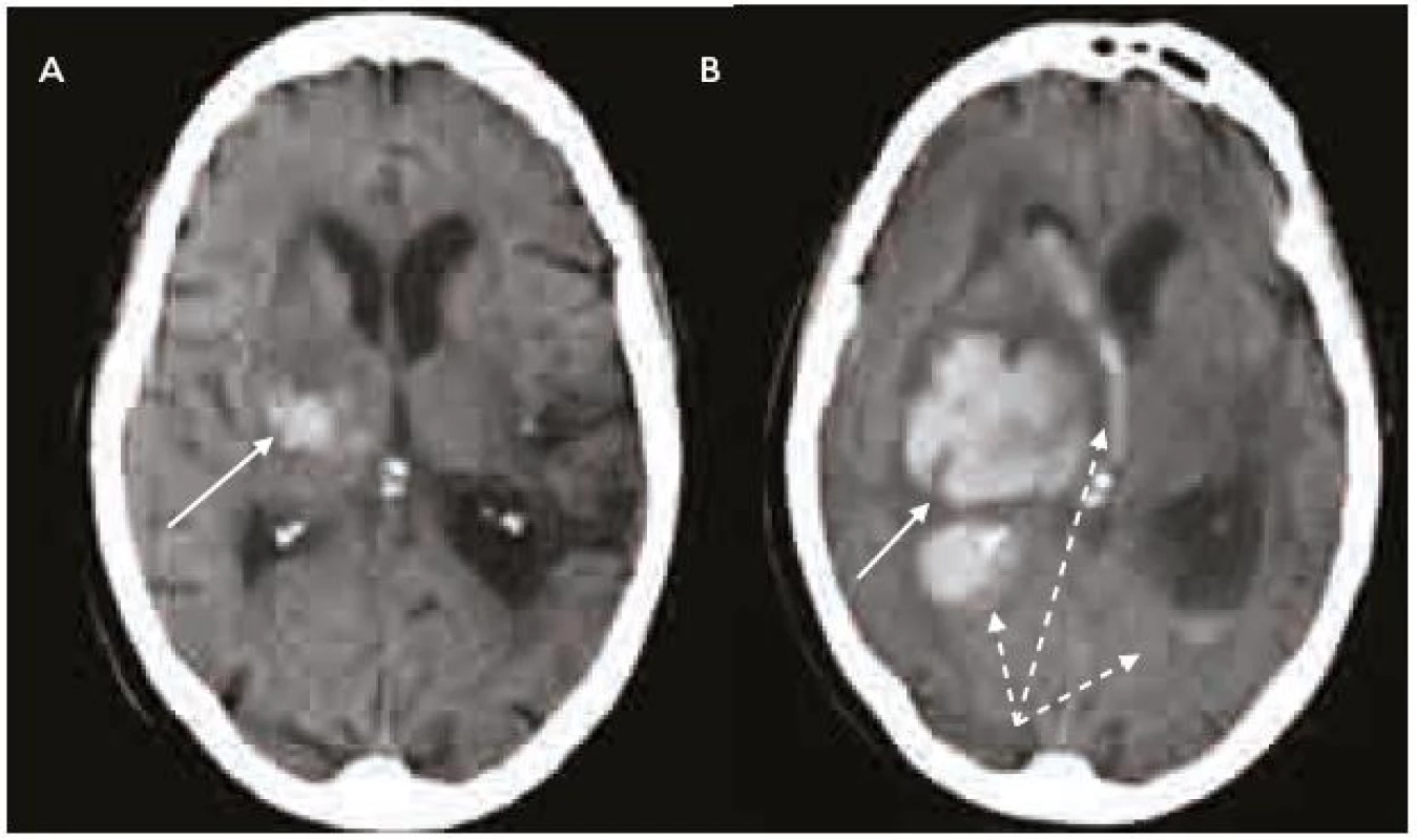 Intracerebrální krvácení u warfarinizovaného pacienta (INR 4,5).
a) Nevelké krvácení v centrálních strukturách pravé mozkové hemisféry (šipka). CT vyšetření 2 hod po příhodě.
b) Výrazná progrese velikosti hematomu (šipka) a provalení krve do komorového systému (přerušované šipky) v důsledku navozené perzistentní koagulopatie. Kontrolní CT vyšetření s odstupem 4 hod.
