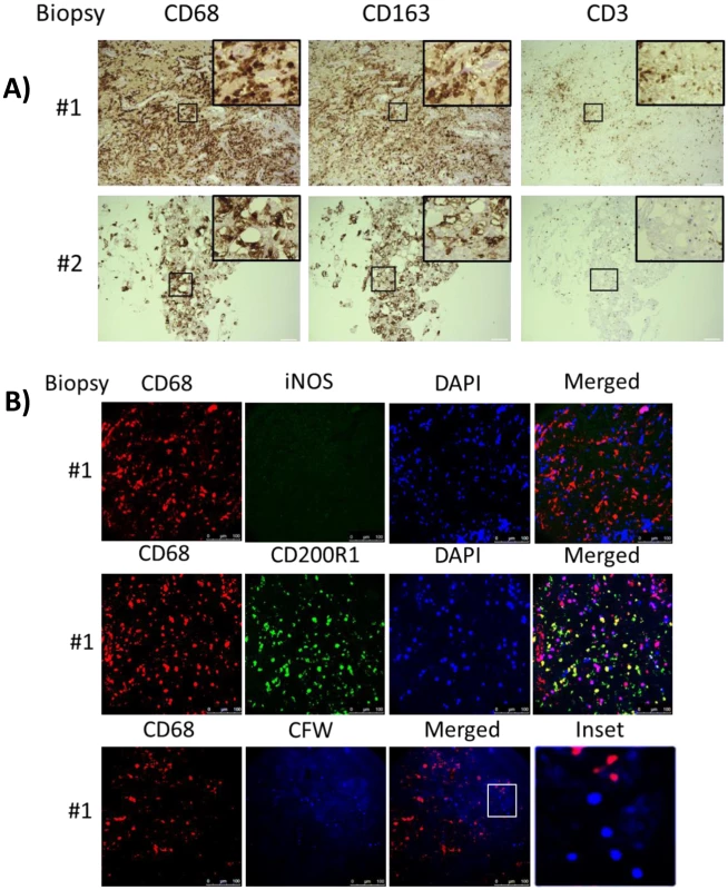 Brain biopsy specimens from patients with s-CNS cryptococcosis demonstrate macrophage and T-cell tissue infiltration.
