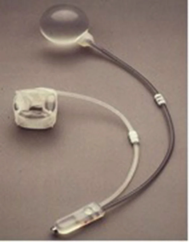 Umělý svěrač anu Acticon Neosphincter – pomůcka
Fig. 1: Artificial anal sphincter Acticon Neosphincter – the device