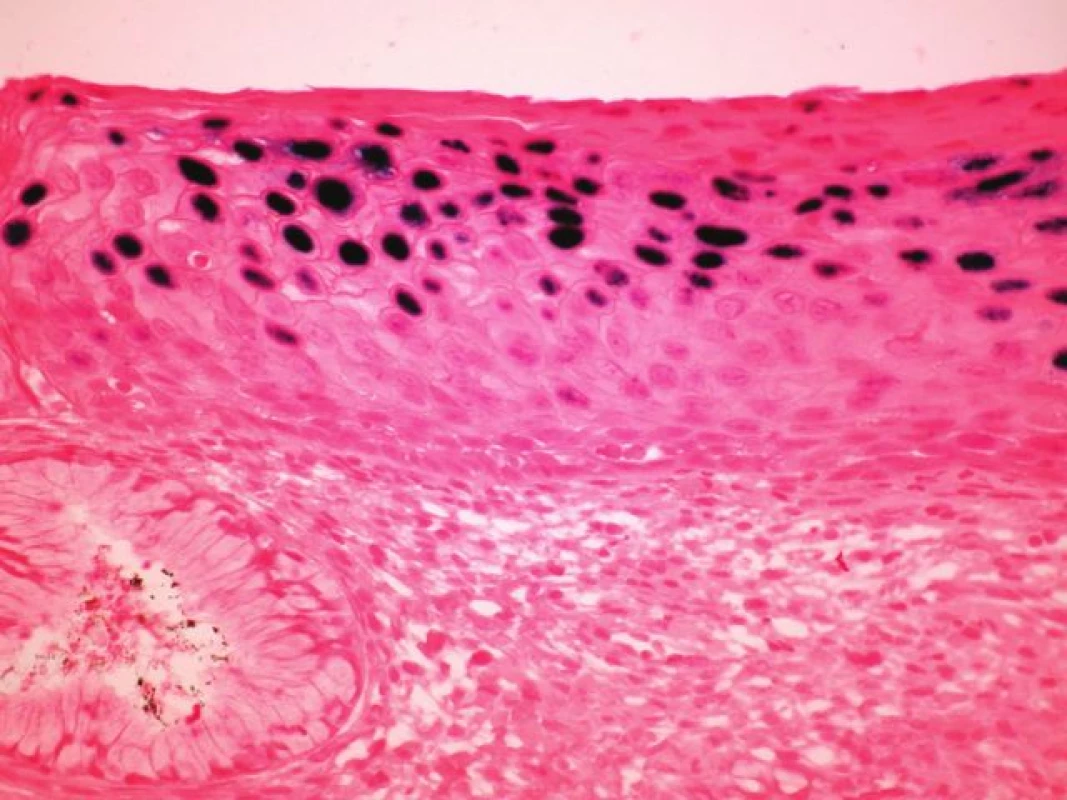 <i>In situ hybridizace</i> (ISH – epizomální typ barvení) u cervikální léze, kde v horních vrstvách dlaždicového epitelu jsou sytě modře difúzně zbarvená jádra svědčící pro DNA HPV v epizomální podobě (INFORM HPV III Family 16 Probe, zvětšení 100x).