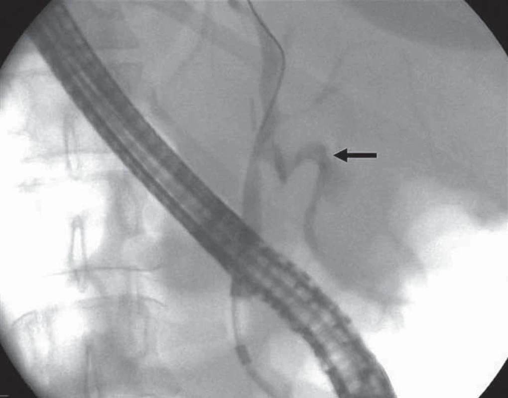 ERCP – ve vzdálenosti (respektive ve výši) asi 6 cm nad Vaterovou papilou odstupuje z extrahepatálních žlučovodů pahýl ductus cysticus (v jeho oblasti je též klip po laparoskopické cholecystektomii) a v této lokalitě je patrný únik kontrastní látky mimo konturu žlučovodů – tedy biliární leak (šipka). Dále je v této lokalitě – tedy v oblasti odstupu pahýlu ductus cysticus – přítomna benigní stenóza choledochu, zřejmě po obtížné laparoskopické cholecystektomii před 3 dny. Pravý ductus hepaticus není znázorněn zřejmě v důsledku obstrukce. Nad obstrukcí se intrahepatální žlučové cesty nezobrazily.
