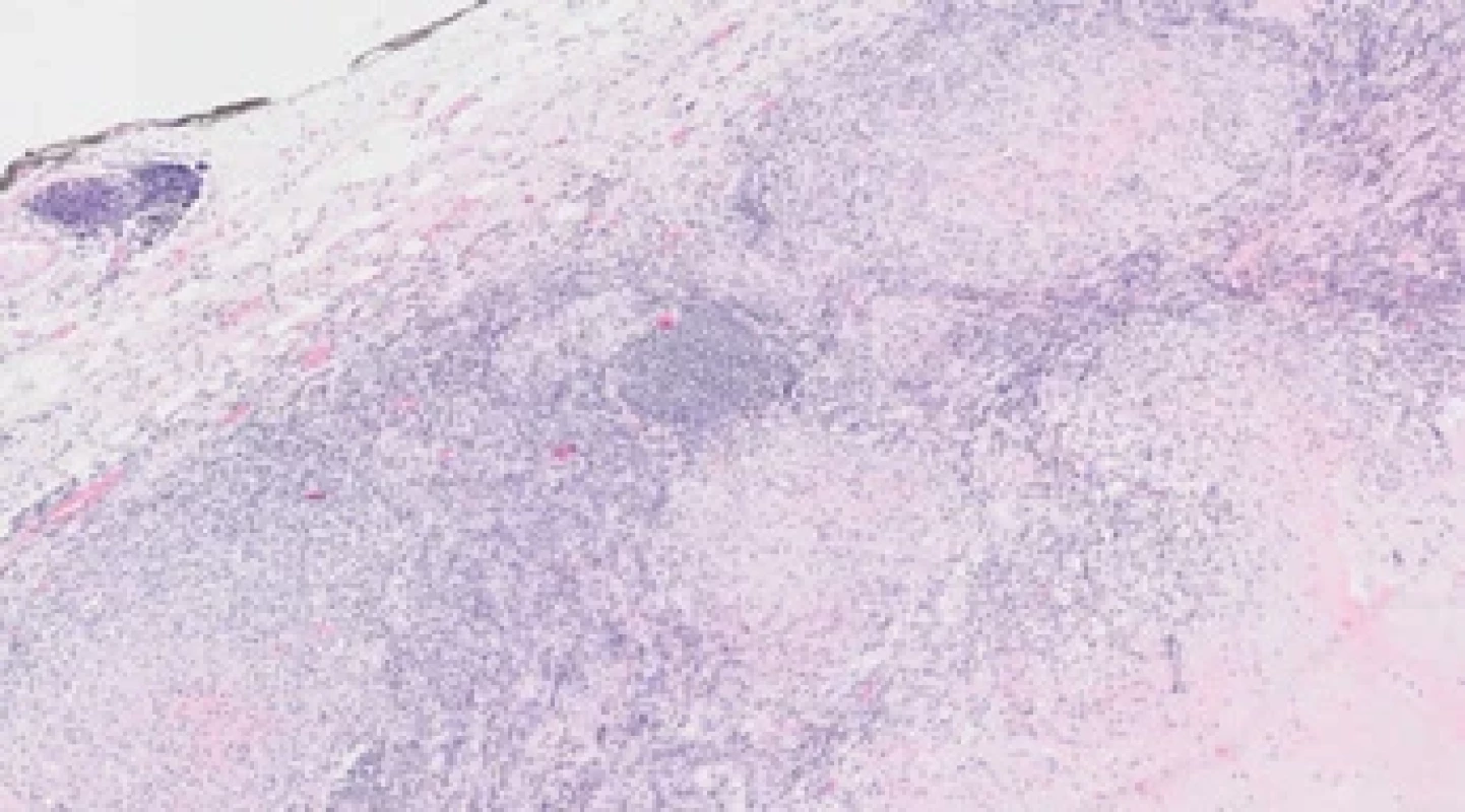 Popis obdobný, v pravém dolním rohu v granulomu eozinofi lní nekróza. Barvení hematoxylin–eozin, zvětšení 200×.