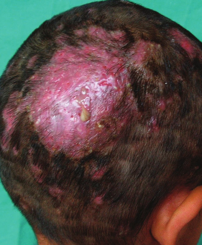 Tinea capitis profunda