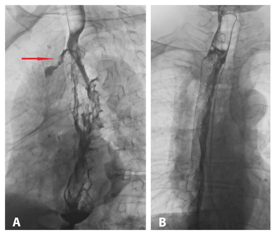 A − ohraničený AL na ezofagografii, B − ezofagografický
obraz utěsněného AL po zavedení stentu<br>
Fig. 5: A − contained AL on esophagography; B − esophagographic
image of a sealed AL after stent insertion
