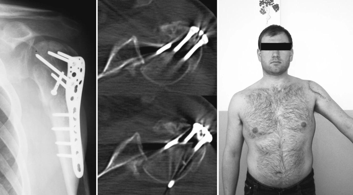 Nepoznaná zadní luxace po osteosyntéze kominutivní zlomeniny proximálního humeru – a) RTG snímek 3M po osteosyntéze, b) CT-nález zadní luxace, c) klinický nález
Pic. 4. Undiagnosed posterior dislocation following osteosynthesis of the proximal humerus comminutive fracture – a) a 3M x-ray view following osteosynthesis, b) a CT finding of posterior dislocation, c) a clinical finding