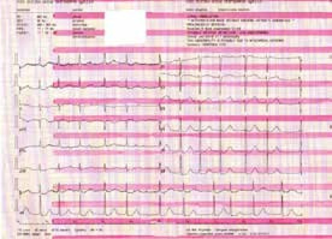 Vstupní EKG