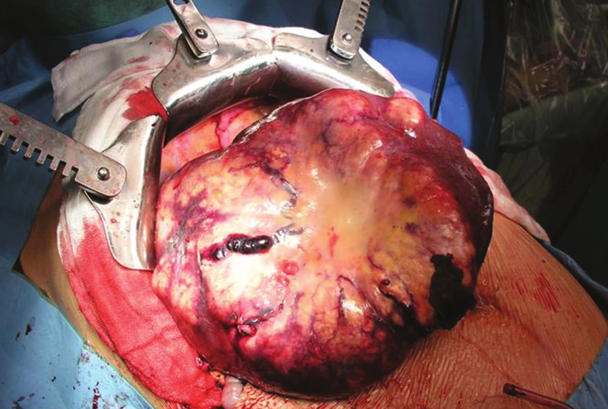 Objemná JMKRK v pravém laloku jater
Fig. 3: Large CLM in the right lobe of liver