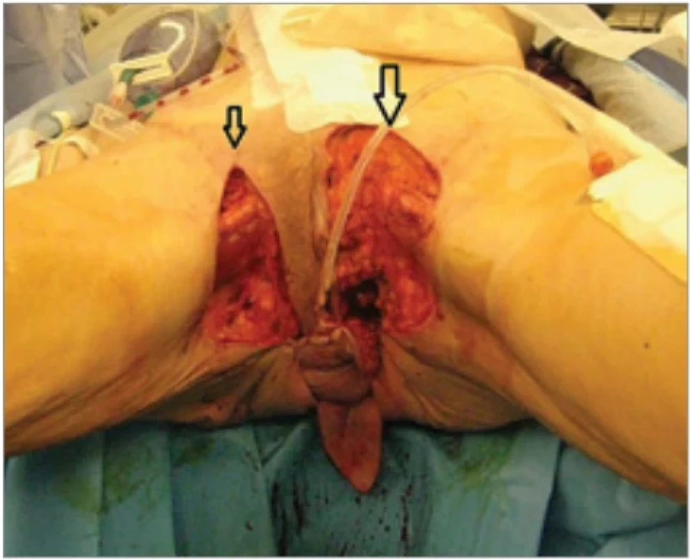  Inguinal lesions are excised; the dissection is extended to the adductor muscles to prepare a recipient bed for bilateral skin graft placement.