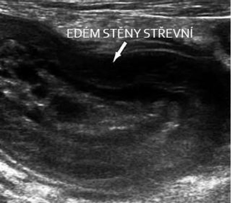 CDAC – aktivní pankolitida s výrazným edémem stěny.
Fig. 11. CDAC – active pancolitis with distinctive wall oedema.