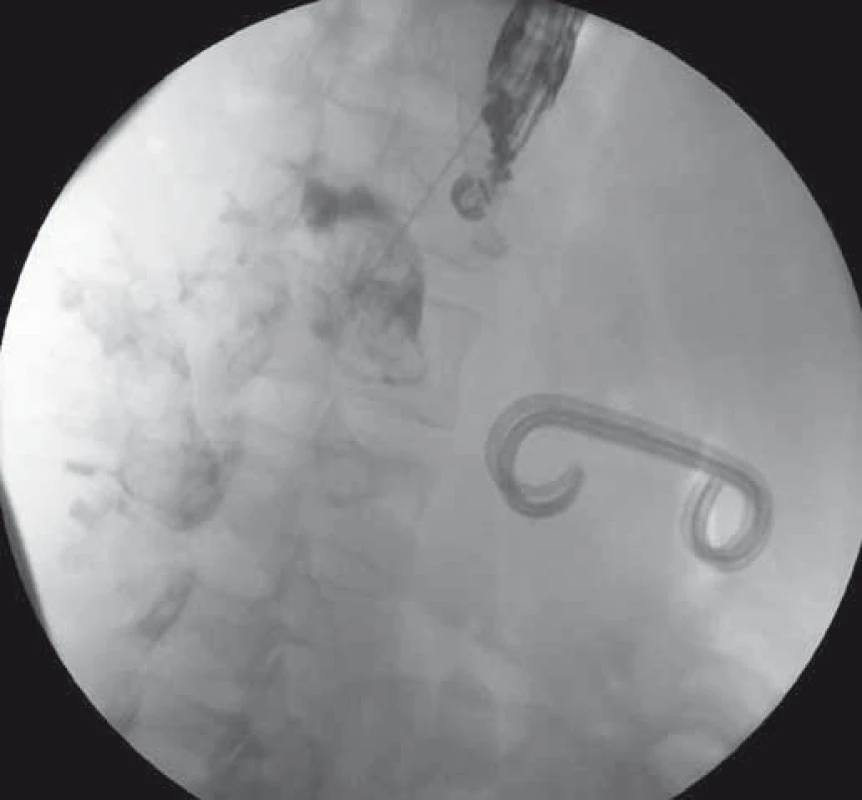 EUS-trangastrálna drenáž WOPN – punkcia a zobrazenie dutiny nekrózy kontrastnou látkou.
Fig. 1. EUS-guided transgastric drainage of WOPN – puncture and imaging of the WOPN cavity with a contrast.