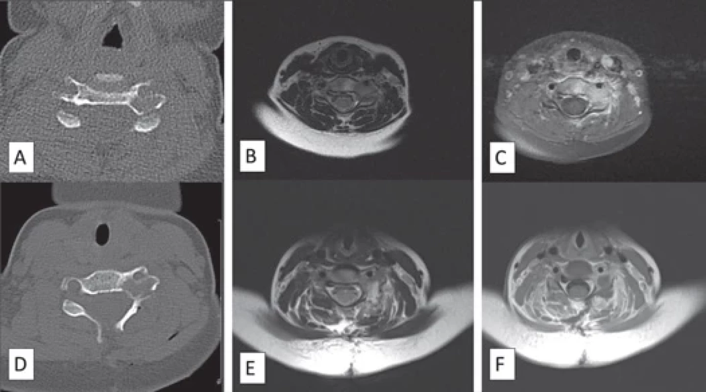 Images of the patient with recurrent osteoblastoma (Patient 11) before recurrence: (A) preoperative axial CT image; (B) preoperative axial T2-weighted MRI image; (C) preoperative axial postcontrast T1-weighted MRI image; (D) postoperative axial CT image; (E) postoperative axial T2-weighted MRI image; (F) postoperative axial postcontrast T1-weighted MRI image.