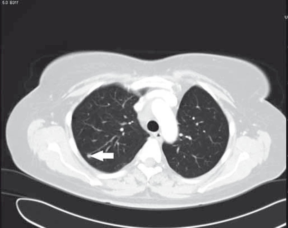 Bílá šipka – druhé metastatické ložisko v pravém horním laloku plic.
Fig. 4  White arrow – second colorectal cancer metastasis in right upper lung lobe.