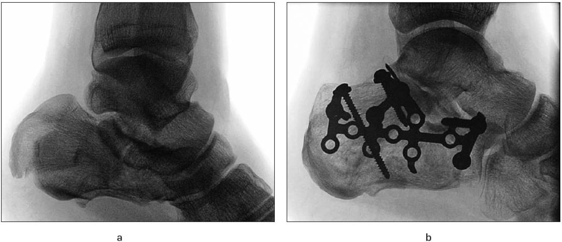 Ošetření zlomeniny patní kosti anatomicky tvarovanou dlahou: