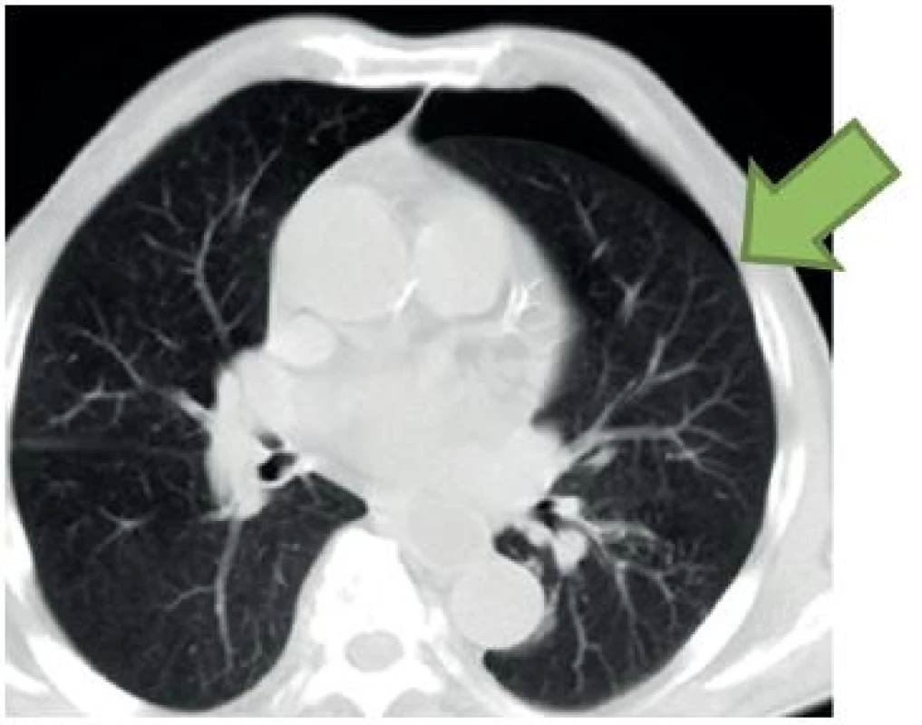Lung point