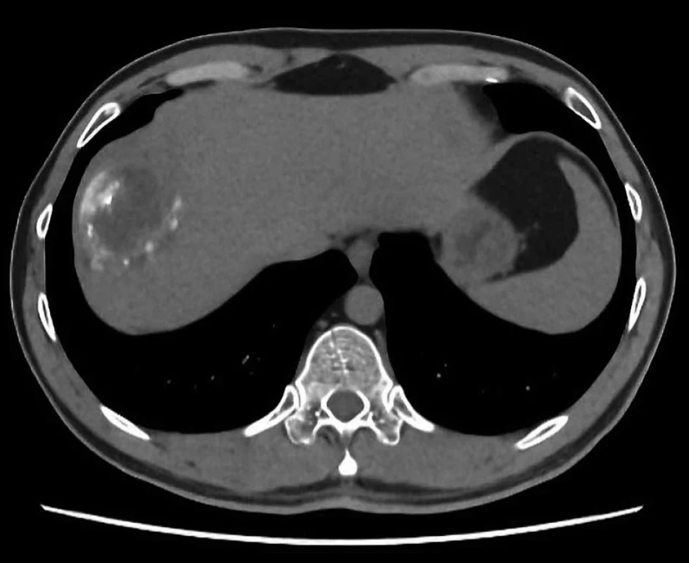 Cystická echinokokóza na CT – segment V