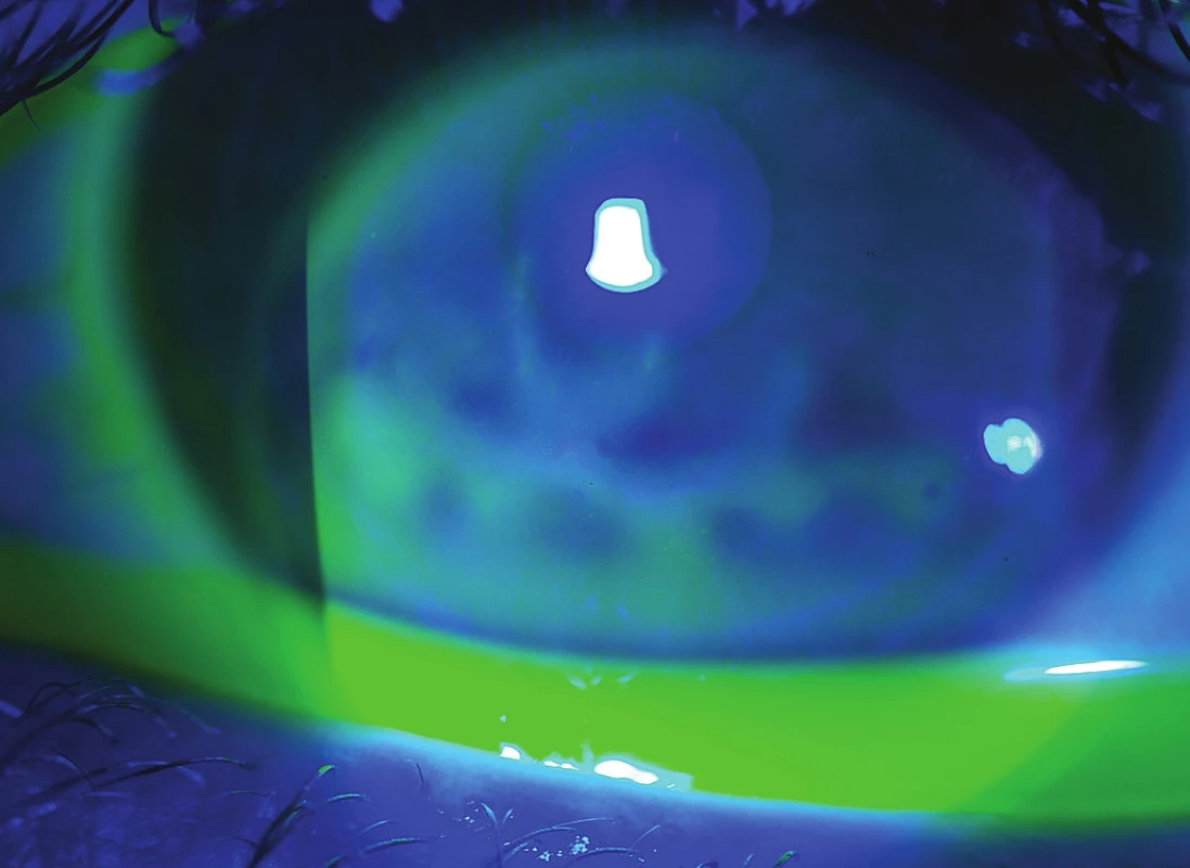Nález po ofarbení fluoresceínom
