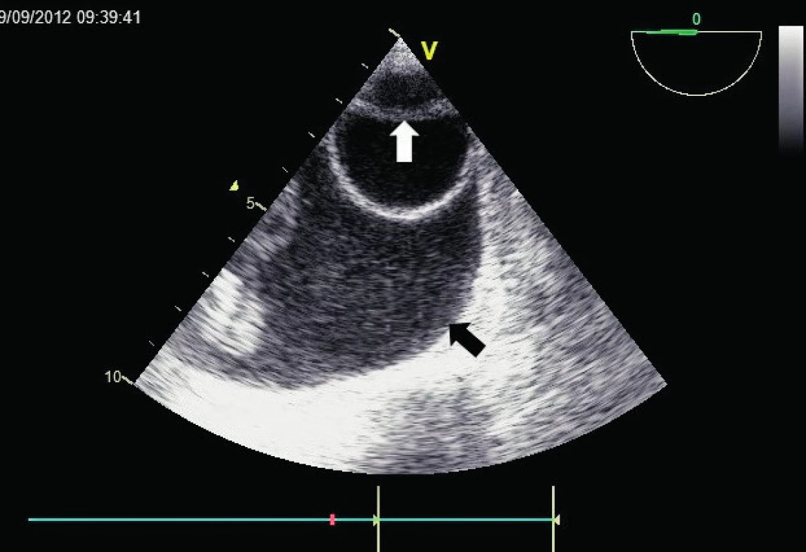 Descendentní aorta v krátké ose
TEE zobrazení sestupné aorty s patrným intimálním flapem (bílá šipka), dělícím její lumen na pravé a falešné. Současně je zřetelný významný levostranný pleurální výpotek (černá šipka).