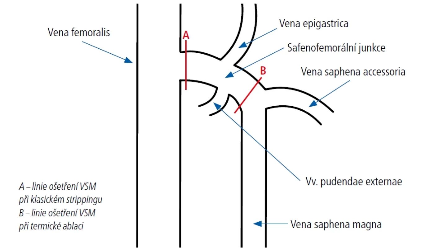 Linie ošetření VSM při klasickém strippingu ve srovnání s linií při ošetření pomocí termální ablace.