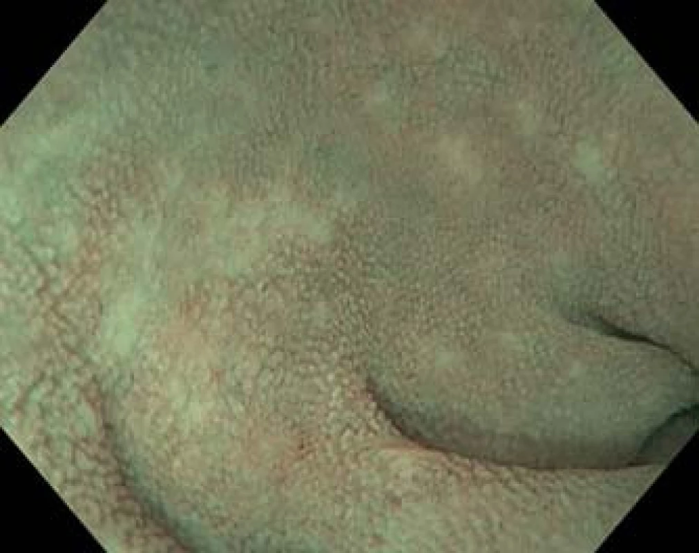 Koloskopie (Olympus CF H180AL). Terminální ileum s obrazem zkrácených klků v obraze NBI (narrow band imaging) ve vodní imerzi.
Fig. 2. Colonoscopy (Olympus CF H180AL). Terminal ileum with shortened villi in NBI (narrow band imaging) and water immersion.
