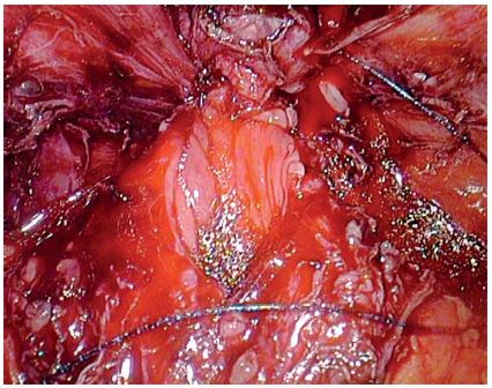 Založení prvního stehu V-Loc
Fig. 3. Setting up the fi rst bite of the stitch V-Loc