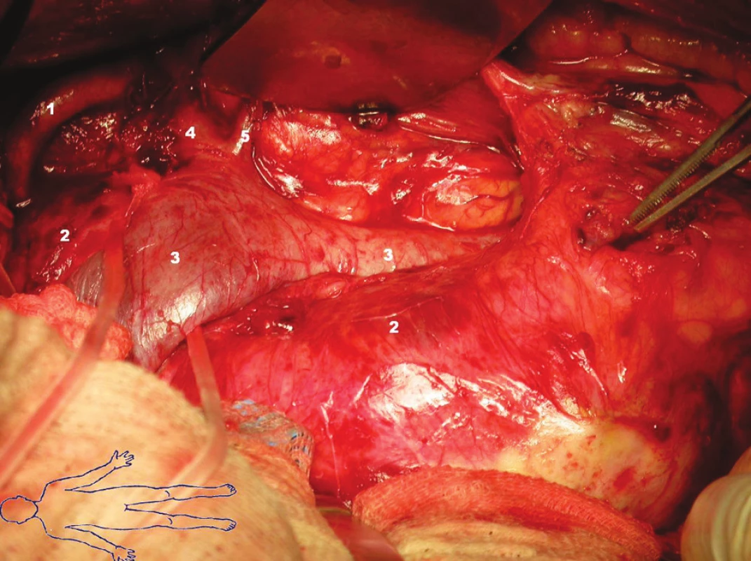 Stav po rozpuštění laparotomie a preparaci jednotlivých cévních struktur:
Fig. 1. St.p. laparotomy and preparation of individual vascular structures:
1 – arteria renalis sinistra
2 – aneuryzma abdominální aorty
3 – vena cava inferior
4 – vena renalis sinistra
5 – vena ovarica sinistra