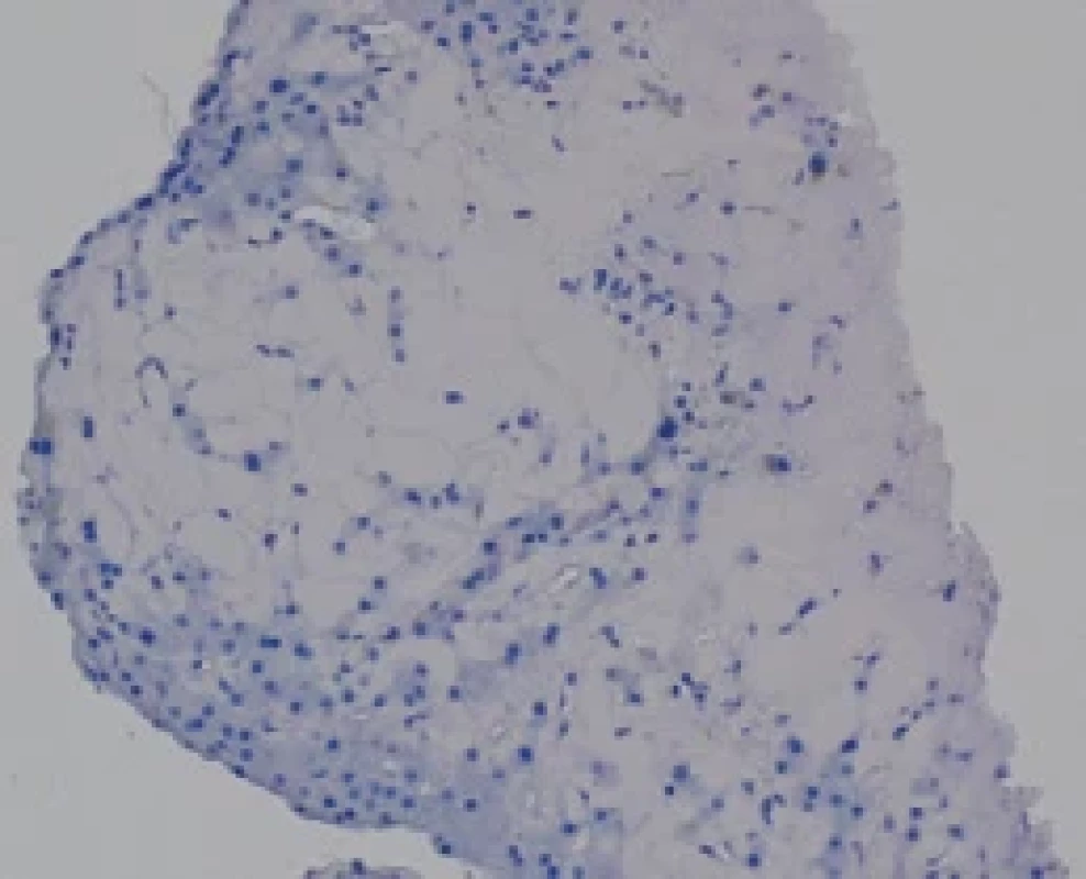 Histologický vzorek prezentovaného případu (Ústavu Klinické a Molekulární Patologie LF UP Olomouc). Vzorek jater barvený Kongo červení s opakovaně negativním výsledkem.